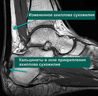 Ахиллесова Сухожилия Где Находится Фото